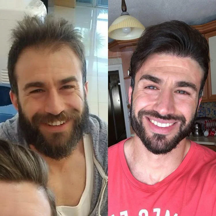 before and after hair transplant