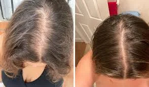 women before and after hair transplant